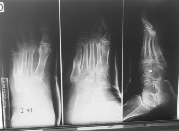 Mal perforant plantaire du 5me mtatarsien