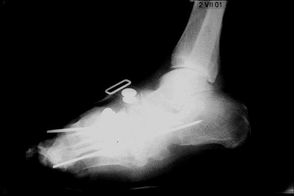 Mal perforant plantaire interne