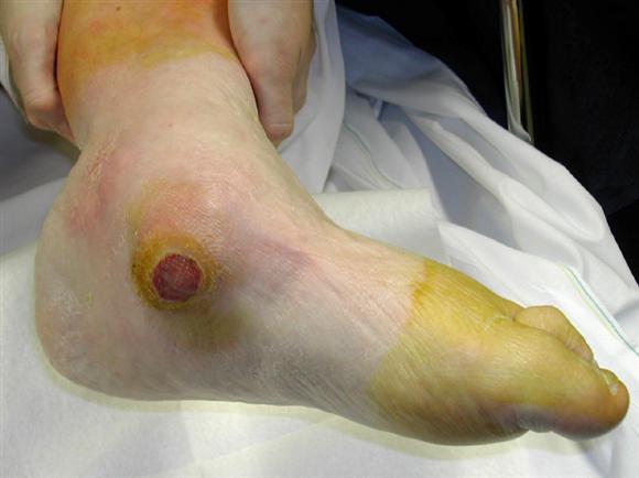 Mal perforant plantaire sous-mallolaire interne